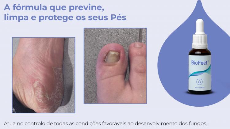 Clinical Case 04 - Patient with dermatomycosis, plantar psoriasis and ingrown nail